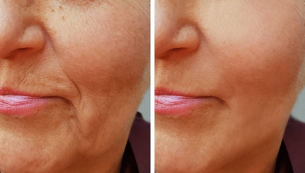 A woman 's face before and after using the peel.