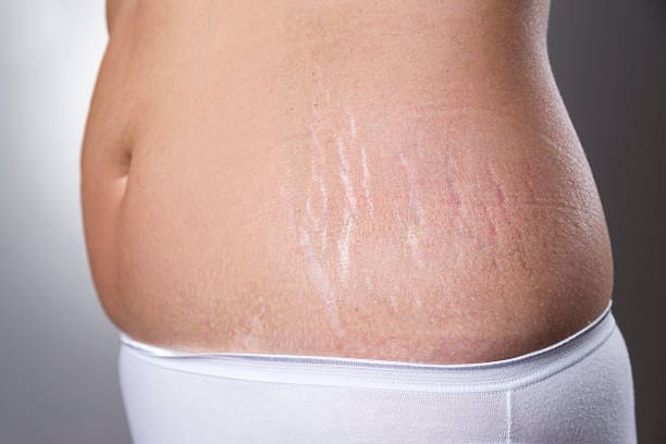 A woman 's stomach with scars on it.