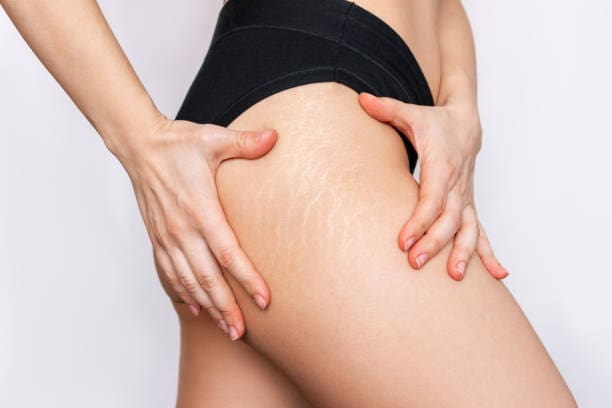 A woman is holding her legs and showing off the cellulite on her buttocks.