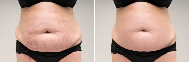 A woman 's stomach before and after surgery.