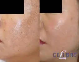 A before and after picture of the skin on a woman 's face.