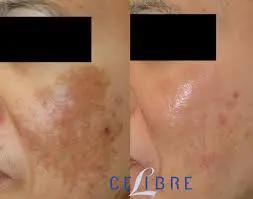 A before and after photo of the skin of a person with acne.