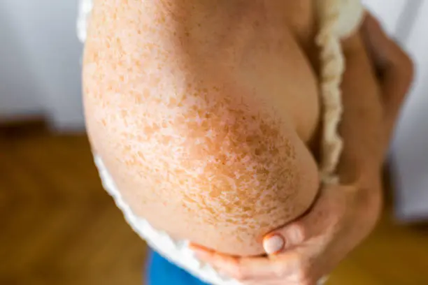 A person with very large bumps on their arms.