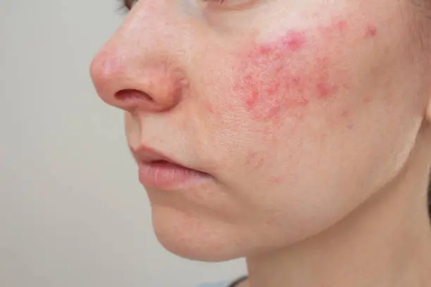 A woman with red spots on her face.