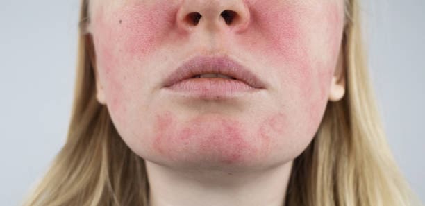 A woman with red spots on her face.